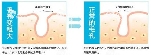 正常毛孔和粗大毛孔