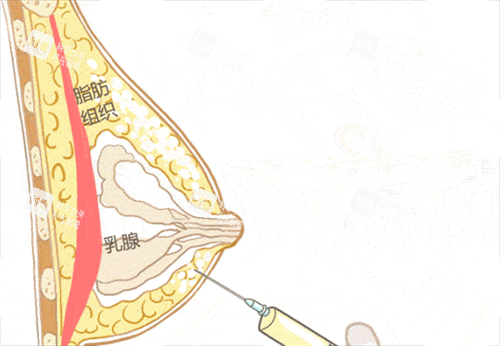 胸部奥美定注射物取出