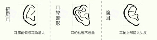 耳畸形种类