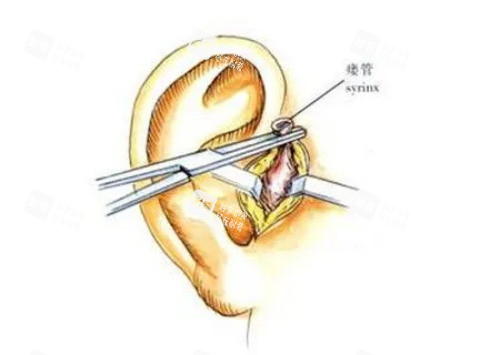 耳前瘘管示意图