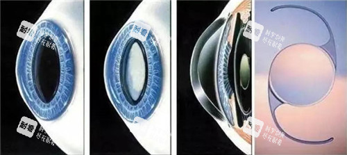 白内障晶体手术细节图