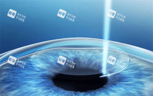 绿飞秒手术过程图解 绿飞秒手术过程图解