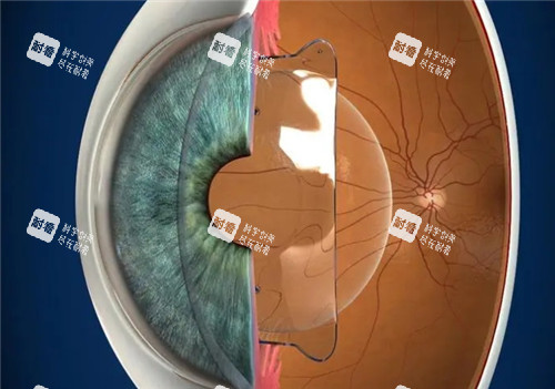 晶体植入近视手术模拟图