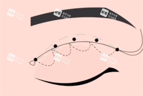 埋线双眼皮