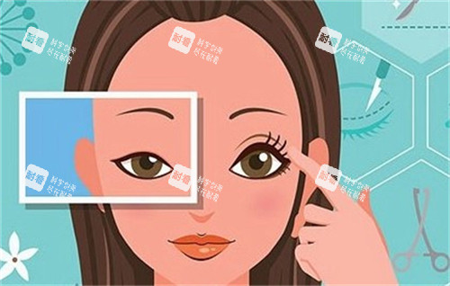 双眼皮手术前后对比