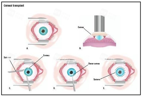 角膜移植手术过程图展示