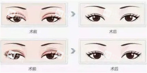 双眼皮修复 双眼皮修复