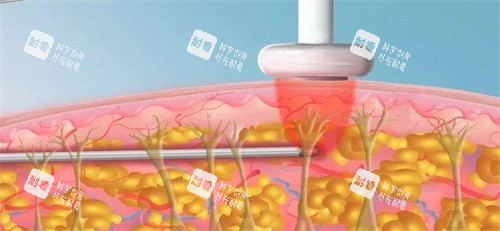 激光溶脂 激光溶脂