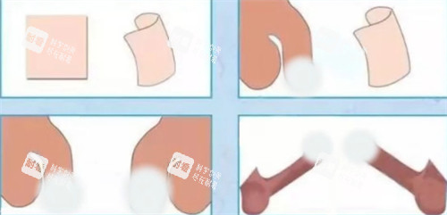 阴茎生物补片手术前后对比