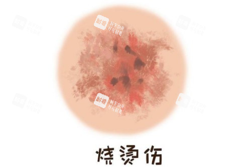 皮肤烫伤疤卡通图 皮肤烫伤疤卡通图