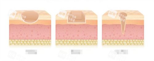 三种不同类型的疤痕 三种不同类型的疤痕
