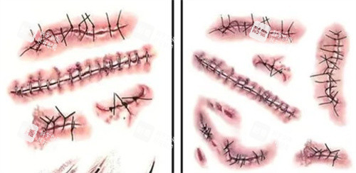 不同的手术疤痕 不同的手术疤痕