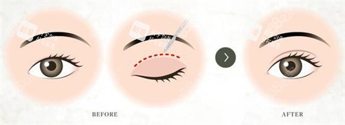 双眼皮术对比宣传图