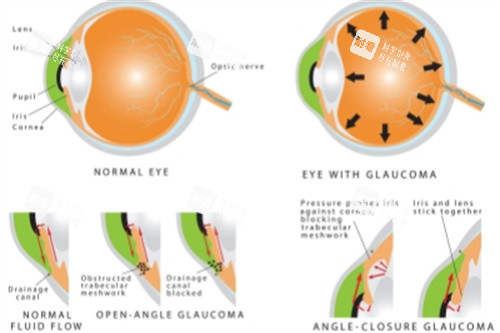 青光眼结构图