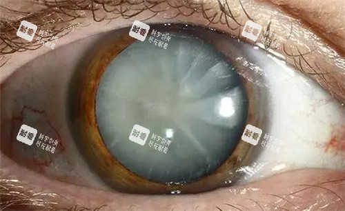 白内障眼球照片 白内障眼球照片