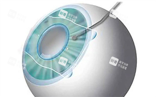 ICL晶体植入示意图 ICL晶体植入示意图