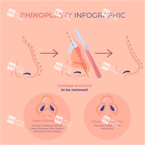 鼻整形过程 鼻整形过程
