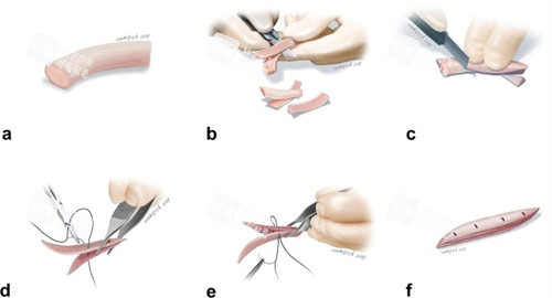 雕刻鼻整形填充物 雕刻鼻整形填充物