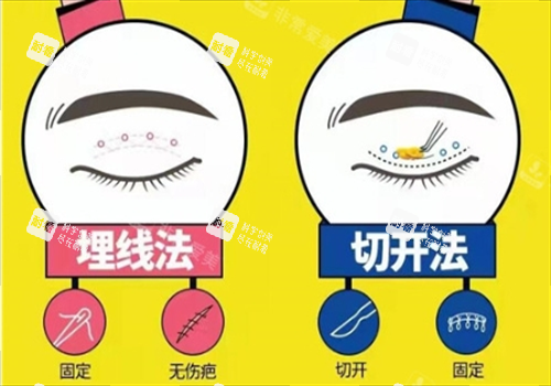 双眼皮埋线和切开对比图