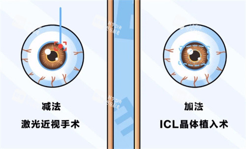 近视手术的分类 近视手术的分类