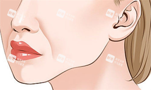 面部衰老法令纹展示图.jpg 面部衰老法令纹展示图.jpg