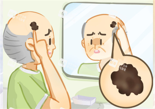 黑色素瘤怎么办 黑色素瘤怎么办