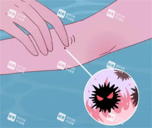 黑色素瘤怎么回事 黑色素瘤怎么回事