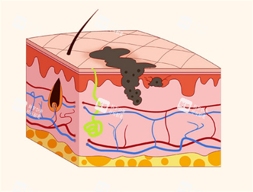 黑色素瘤在皮肤下的层次 黑色素瘤在皮肤下的层次