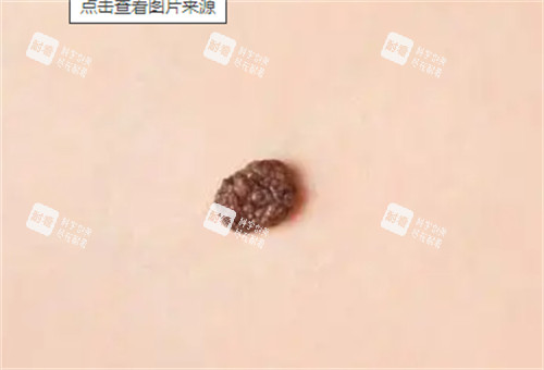 黑色素瘤 黑色素瘤