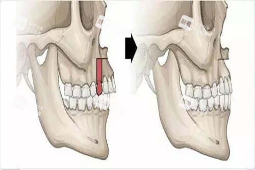 骨性凸嘴正颌示意图