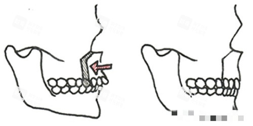 正颌手术图片