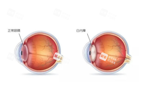 正常眼睛与白内障眼镜对比图 正常眼睛与白内障眼镜对比图