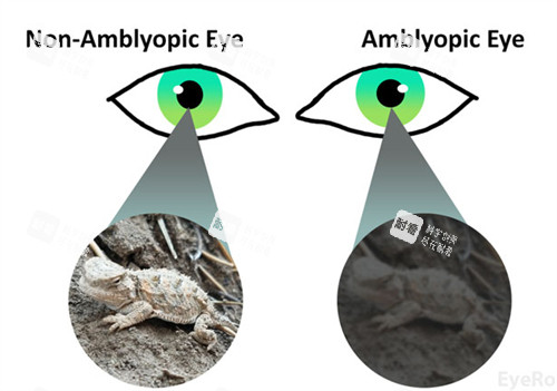 弱视和正常眼睛看物体不同