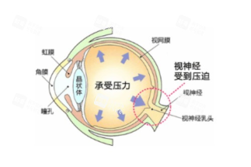 眼睛眼压高概念图 眼睛眼压高概念图