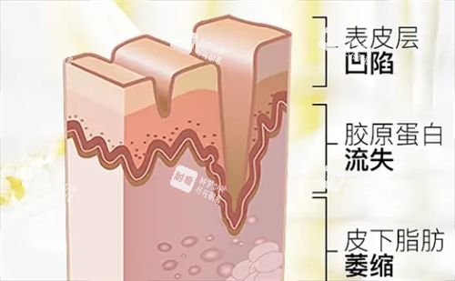 皮肤皱纹皮下组织剖面图
