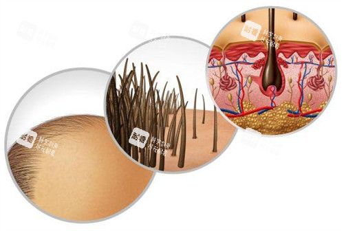 脂溢性脱发造成的问题