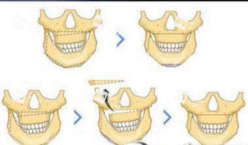 正颌流程示意图 正颌流程示意图