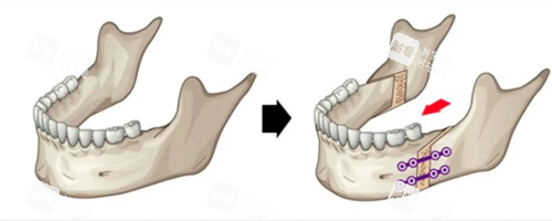 正颌手术 正颌手术