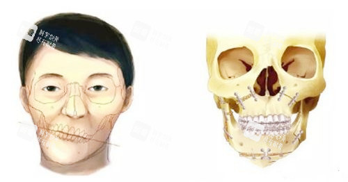 正颌手术对比图 正颌手术对比图