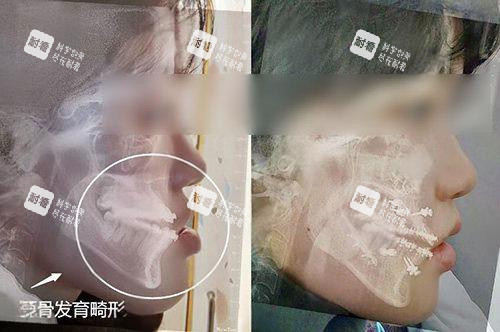 地包天正颌手术前后对比 地包天正颌手术前后对比