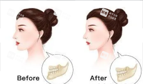 正颌手术后的成效图片