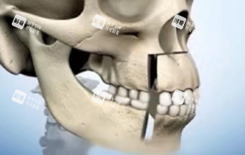 正颌手术图示 正颌手术图示