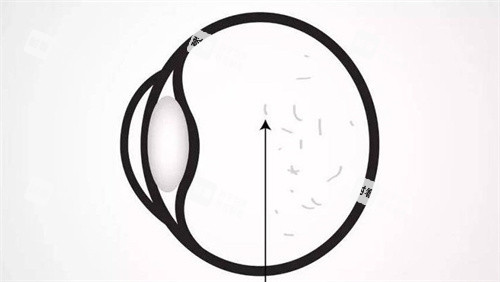 飞蚊症的眼部 飞蚊症的眼部