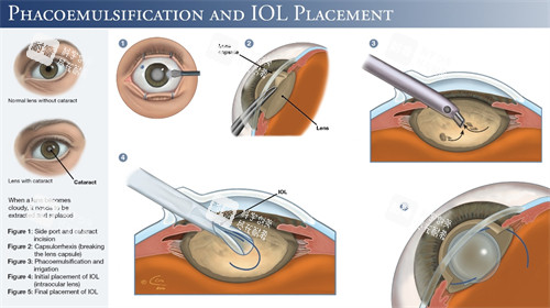 超声乳化白内障手术细节图 超声乳化白内障手术细节图