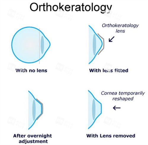 角膜塑形镜工作流程 角膜塑形镜工作流程