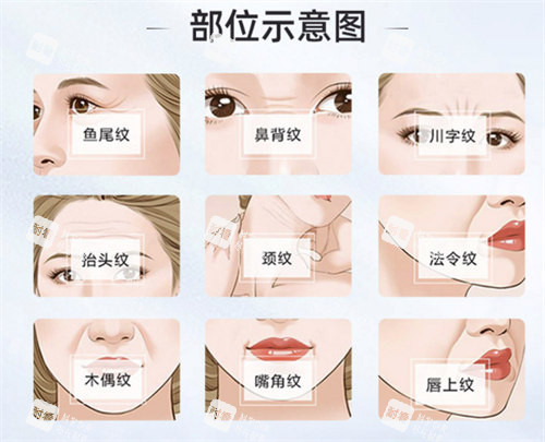 面部除皱部位演示动画图 面部除皱部位演示动画图