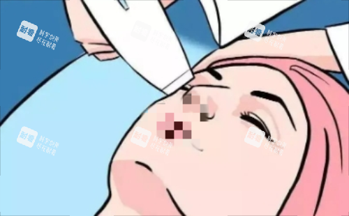 激光除皱示意图 激光除皱示意图