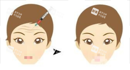 打针除皱前后对比图 打针除皱前后对比图