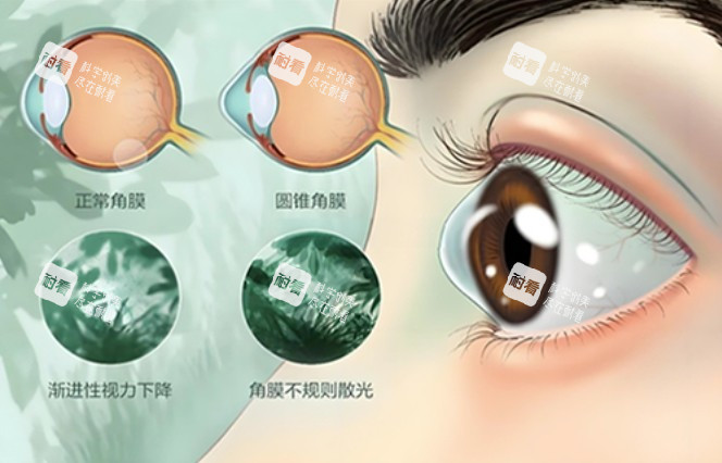 巩膜镜改善问题