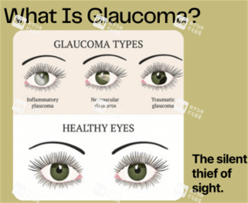 什么是青光眼 什么是青光眼